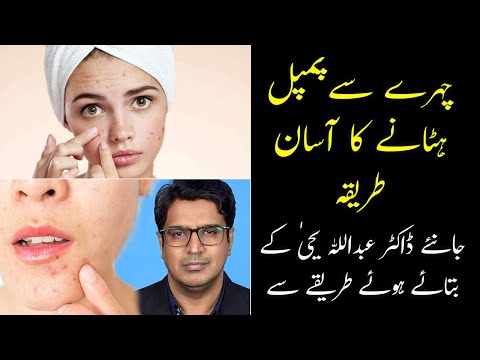 Acne Vulgarism And Its Treatment By Dr. Abdullah Yahya