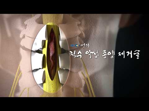 [명의 의학백과📖] 척수 악성 종양 제거술