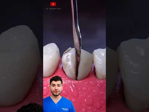 Cracked a Tooth? BUY FATGLOB TODAY !