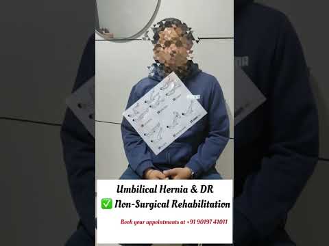 Diastasis Recti and hernia in men : Arogya physiotips #diastasisrecti