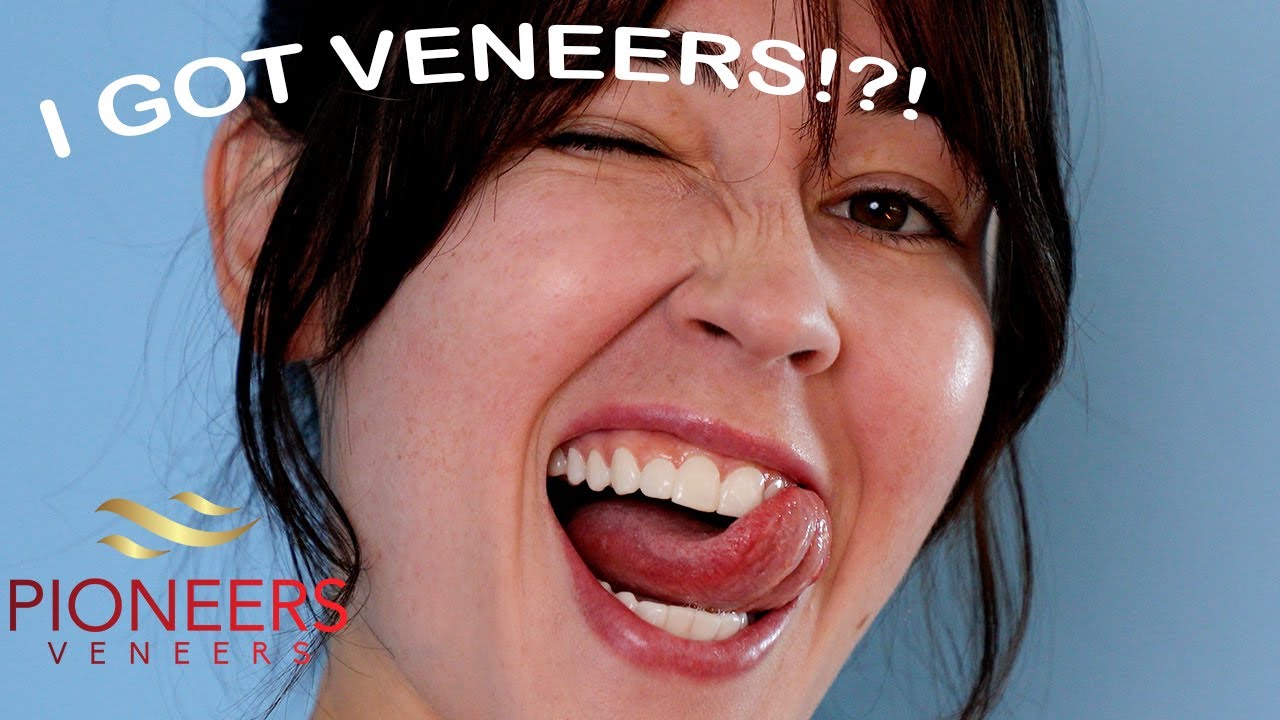 Trying Snap-On Veneers from Pioneers Veneers!!