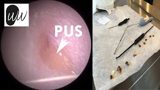500 - Ear Wax Removal in Young Girl with Tragal Pus and Otitis Externa