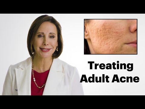 What is Adult Acne and How do I Treat It? - UCb0tMboxhHE8Jx6-nhJmRPw