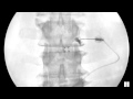 Lumbar Transforaminal Epidural - Neurogram to Epidural with an Extra Millimeter  - ThePainSource.com