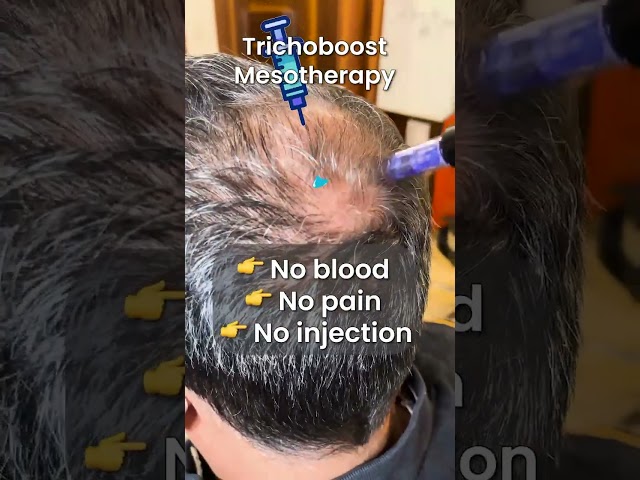 Trichoboost Mesotherapy is a painless, non-invasive, and injection-free treatment that focuses on nourishing your hair roots, promoting growth, and reducing hair fall — all while keeping you comfortable and at ease.


Mesotherapy is a painless non-injection technique. With the help of a Dermapen or Mesotherapy machine, we infuse tiny droplets of products like peptides and growth factors directly into the hair roots  without using your blood. Therefore, it is almost negligibly painful.

✅ No Blood, No Pain, Injection-free.
✅ Safe, effective, and suitable for all hair types.
✅ Boosts circulation, strengthens hair from the roots, and stimulates natural growth.


If you’re looking for a way to bring back volume, thickness, and health to your hair without any invasive methods, this might be exactly what you need.

Transform your hair the natural way!

➡ Comment “Trichoboost” and we’ll share all the details with you.


Disclaimer

The content provided on this page is purely for informational purposes. The reel does not aim to provide any kind of diagnosis, medical advice, or treatment prescriptions. It is important to consult a licensed Dermatologist before undergoing any of these treatments.

Dr Suruchi Puri (Hair & Dermatology Clinic)
📍B-1/37, First Floor, Janakpuri, New Delhi 58

👇Book your appointment
📞98680 80340


#TricoBoostTherapy #HealthyHair #HairFallSolution #NonInvasiveHairTreatment #SafeAndEffective #StrongerHair #HairBoost #PainlessProcedure #NoBloodNoPain #HairGoals #HealthyScalpHealthyHair #HairCare #TransformYourHair #BoostYourConfidence #HairFallControl