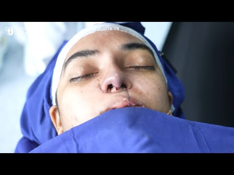 Amazing Nose Job Transformation in India | Before & After Results