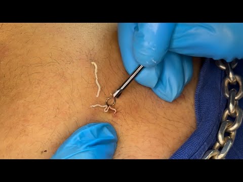 #69 Remove Acne on Back
