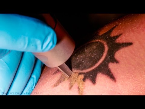 How Laser Tattoo Removal Works - Smarter Every Day 123 - UC6107grRI4m0o2-emgoDnAA