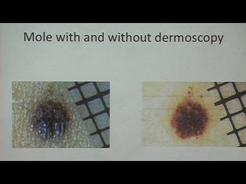 Melanoma and Nonmelanoma Skin Cancer - UCh6KFtW4a4Ozr81GI1cxaBQ