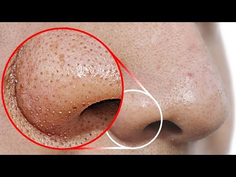 Do THIS to Remove Blackheads From Your Nose - UC4rlAVgAK0SGk-yTfe48Qpw