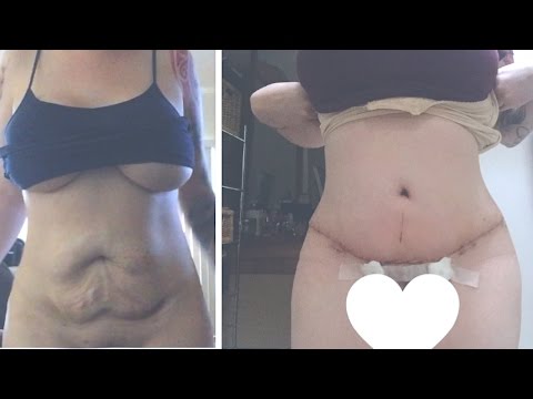 My tummy tuck experience | Q&A - UCcZ2nCUn7vSlMfY5PoH982Q