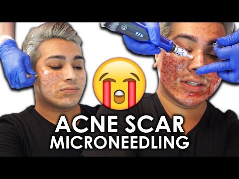 FIXING MY ACNE SCARS (TEXTURED SKIN) | $400 Vampire Facial Treatment - UCINqHpYYqlCPyW1h12M0vtA