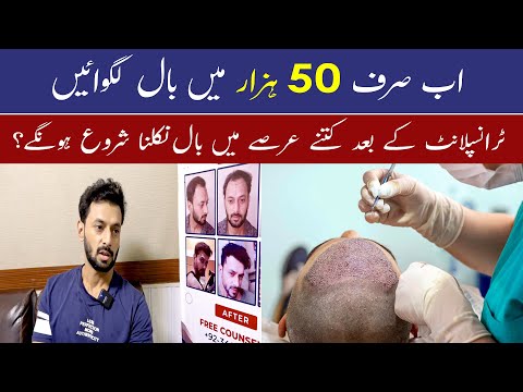 Hair Transplant in Pakistan