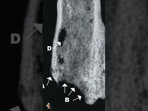 Amputation 31 THOUSAND YEARS AGO #shorts #ancient
