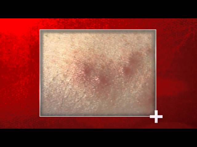 Do Bed Bug Bites Look Like Pimples