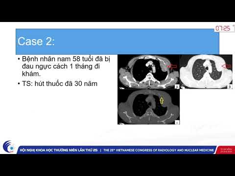 3. Báo cáo về hai trường hợp ung thư biểu mô tế bào dạng Sarcoma ở phổi (BS. Ngô Xuân Thắng)
