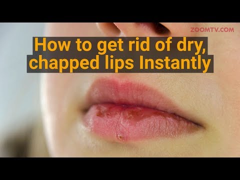 How to get rid of chapped lips instantly | Beauty and grooming tips