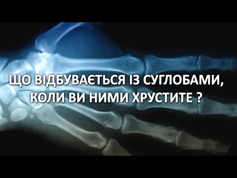 Що відбувається із суглобами, коли ви ними хрустите?