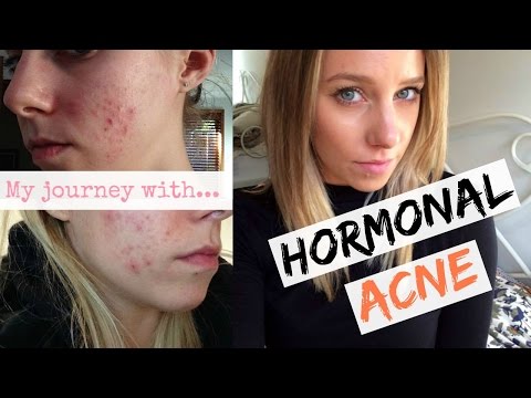 Hormonal Acne + The Pill: Curing My Hormonal Acne Naturally - UCAHufvd02viJSRdt3ojdPOg