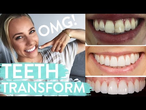 TEETH TRANSFORMATION | Porcelain Veneers | Before & After + Review - UCAHufvd02viJSRdt3ojdPOg