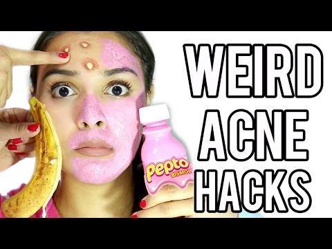 10 WEIRD Acne & Zit Hacks that work FAST! - UCIOUkPJZtWThQBtkCRniSBw