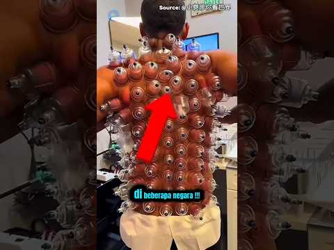 Fakta Unik Tentang Bekam — Terapi Tradisional yang Bikin Tubuh Ringan dan Sehat! #shorts #Bekam