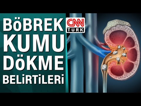 Böbrek kumu dökme nedir? Belirtileri nelerdir?