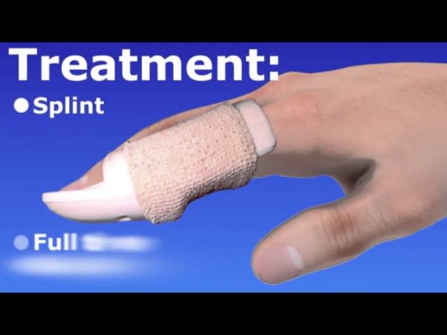 How to Avoid a Baseball Finger Injury