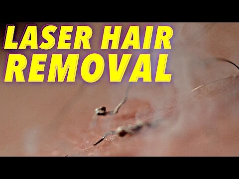 Science of Laser Hair Removal in SLOW MOTION - UCHnyfMqiRRG1u-2MsSQLbXA