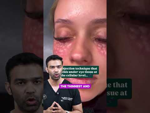 Dark Circles Solved: PRP for Under-Eye Rejuvenation | Natural Treatment Explained