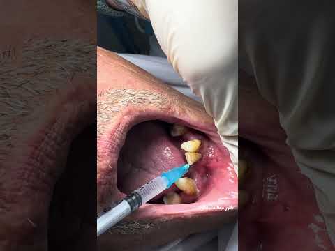 Extraction Forceps For the lower lateral incisor#dr_abdullah_sultan_dentist #extractionteeth