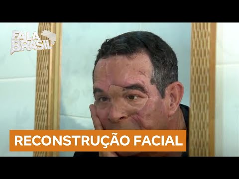 Boa Notícia: Impressora 3D transforma vidas e devolve rosto a pacientes que foram mutilados