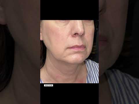 Early healing, beautiful progress #deepplanefacelift #necklift #faceliftjourney #facialaesthetics