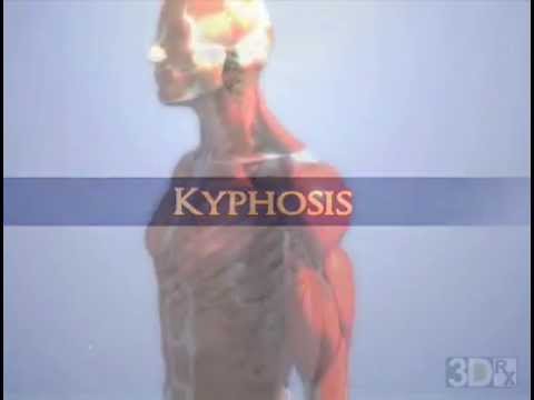 Kyphosis - YouTube