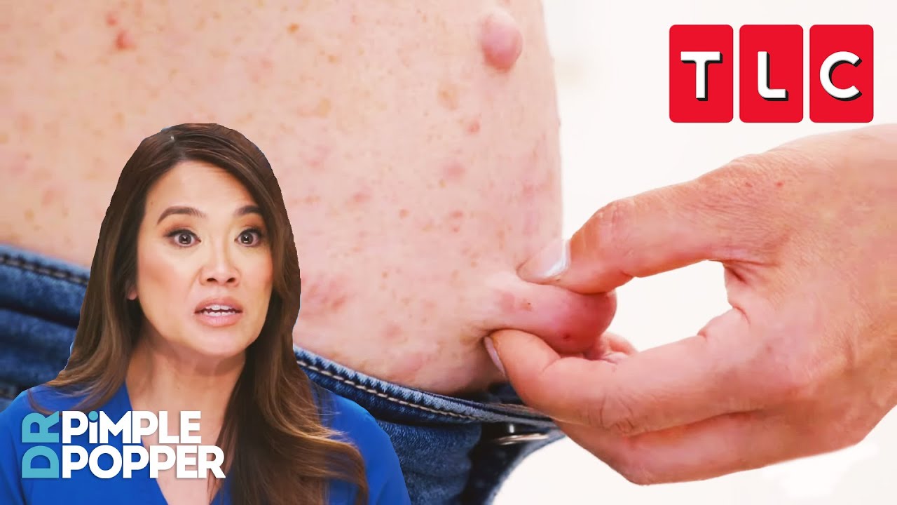 This Woman Is Covered in HUNDREDS of Bumps! | Dr. Pimple Popper | TLC