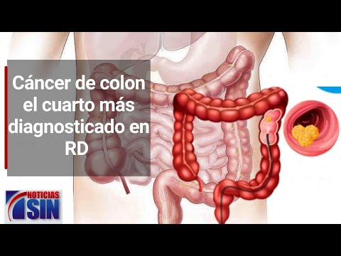 Cáncer de colon el cuarto más diagnosticado en RD