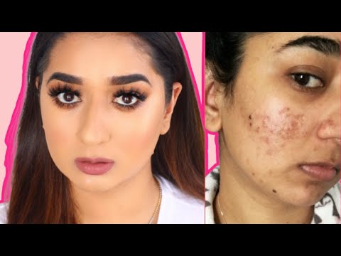 Hindi Video How To Cover Acne & Scars | Easy Makeup Transformation Routine  (IF You Want To) - UCdjWHfiNVnvuJJ1WnviAGcA