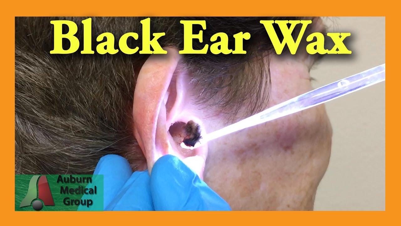 black-ear-wax-removal-auburn-medical-group-racer-lt