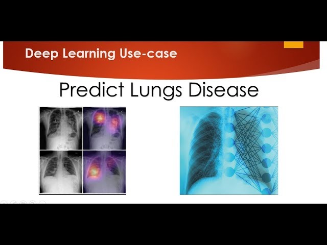 Could Machine Learning Help Us Treat COPD?