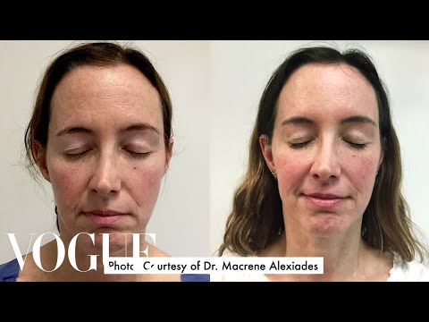 One Woman Gets 15 Cosmetic Procedures in 12 Months | Vogue - UCRXiA3h1no_PFkb1JCP0yMA