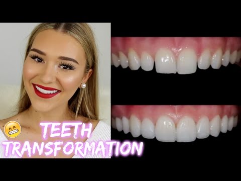 I Got Porcelain Veneers! | SHANI GRIMMOND - UCPG6A5tNaPfv2SRNW2beq5Q