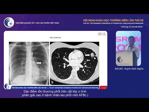 3. Đặc điểm tổn thương phổi trên HRCT ở bệnh nhân lao phổi mới AFB âm (BS.CKII. Huỳnh Đình Nghĩa)