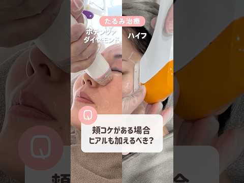 たるみと頬コケが気になる!マシン施術だけでは不十分? #ハイフ #ヒアルロン酸 #アズクリニック