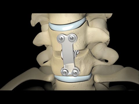 Back Surgery: Spinal Fusion - UC85VW73bQLEjs_taFKP7TwQ