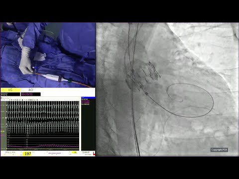 Align for the future with the novel balloon expandable Myval transcatheter heart valve series