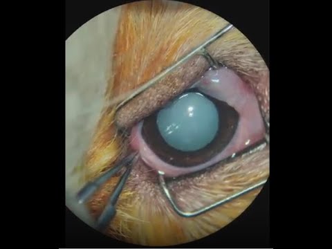 Facoemulsificação IA