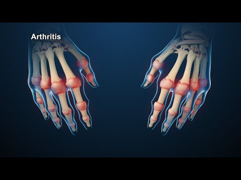 Rheumatoid Arthritis | Nucleus Health - UC85VW73bQLEjs_taFKP7TwQ