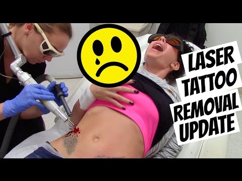 LASER TATTOO REMOVAL UPDATE - UCXof-FuAhf5_l9nJAY_E8gA