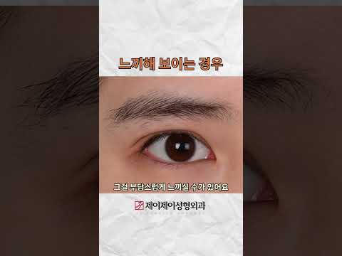 느끼해 보이는 경우 #눈매교정 #shorts