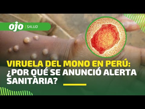 VIRUELA DEL MONO: alerta epidemiológica ya rige en Perú